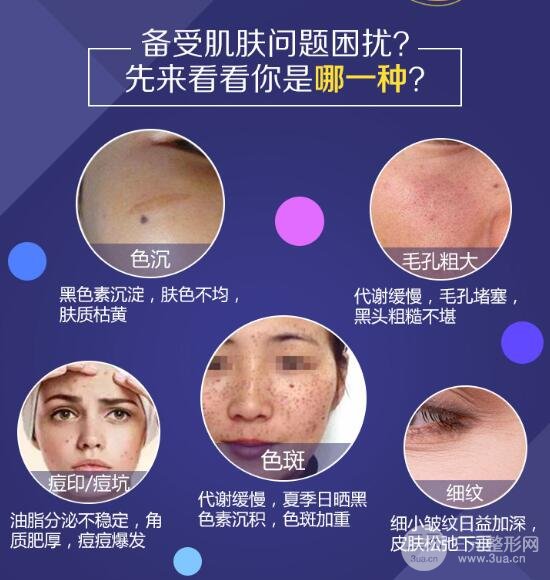 哪些人适合光子嫩肤?