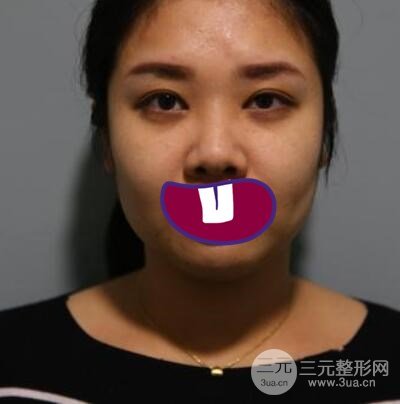 光子嫩肤真人体验果反馈