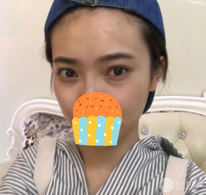 光纤微创溶脂去眼袋果