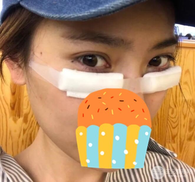 光纤微创溶脂去眼袋术后