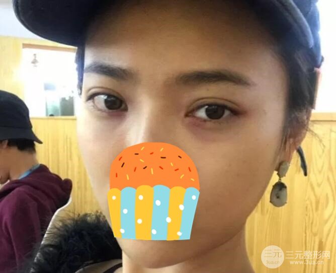 光纤微创溶脂去眼袋术后一个月