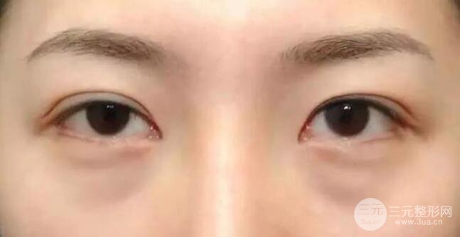 光纤微创溶脂多少钱？光纤微创溶脂去眼袋果