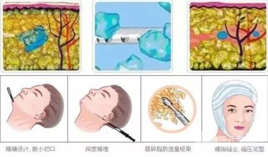 光纤微创溶脂多少钱?