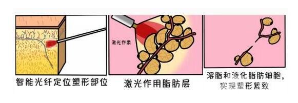 光纤微创溶脂多少钱?