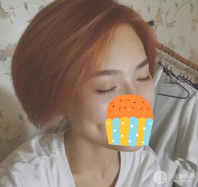 光纤微创溶脂去眼袋术后2个月
