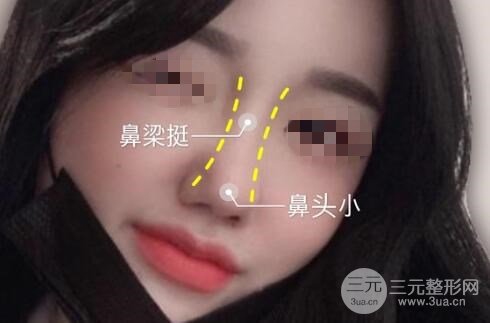 鼻头缩小手术的注意事项是什么?
