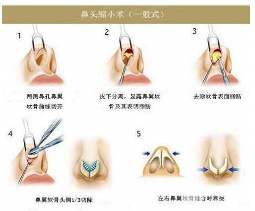 鼻头缩小手术原理简介