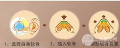 软骨隆鼻术价格多少？为什么有的人做的贵还做不好?