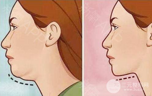 去除双下巴