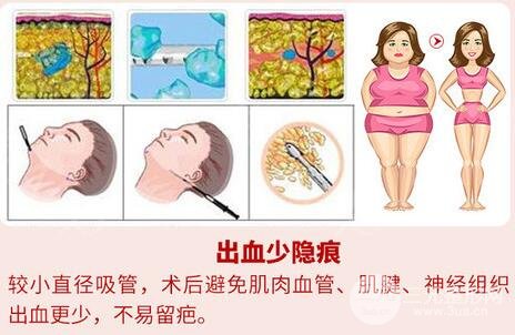 手术原理