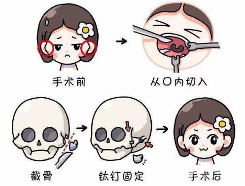 颧骨颧弓整形手术过程