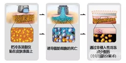 酷塑冷冻溶脂的果能维持多久