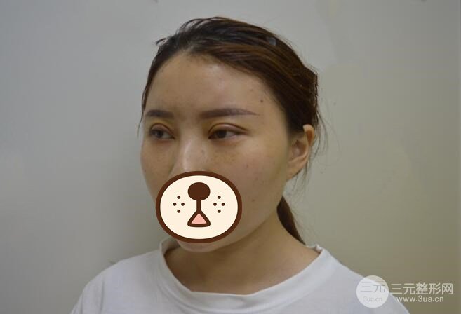 埋线双眼皮恢复过程图