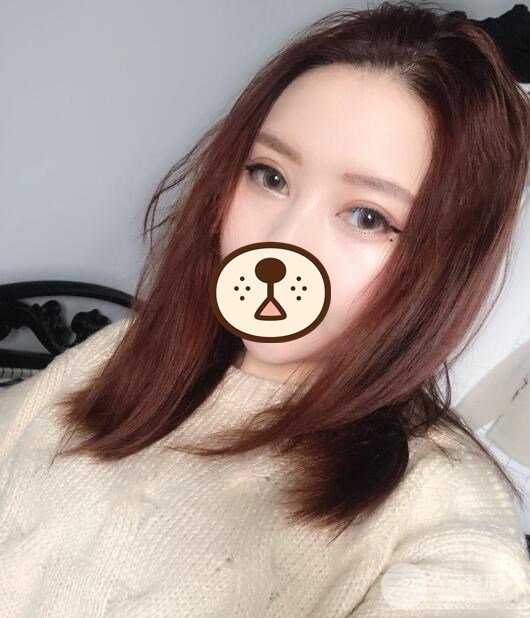 埋线双眼皮恢复过程图