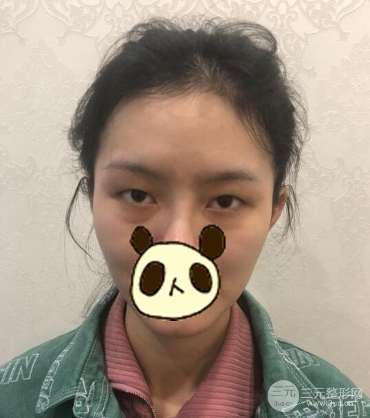 双眼皮案例参考