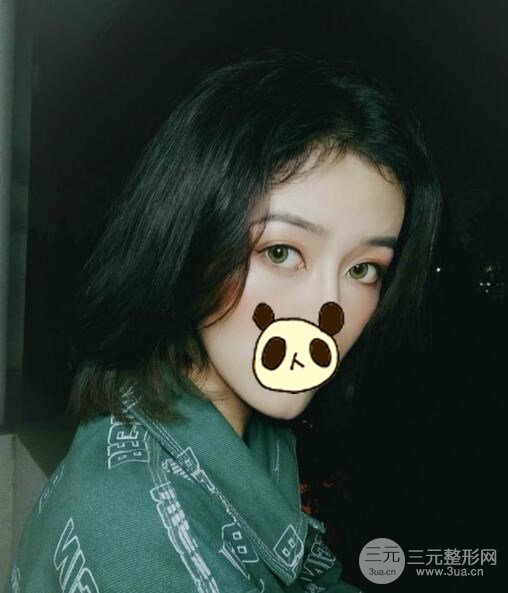 双眼皮案例参考