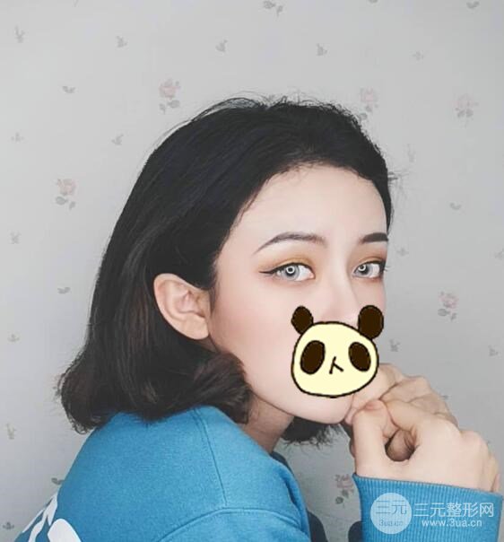 双眼皮案例术后1个月