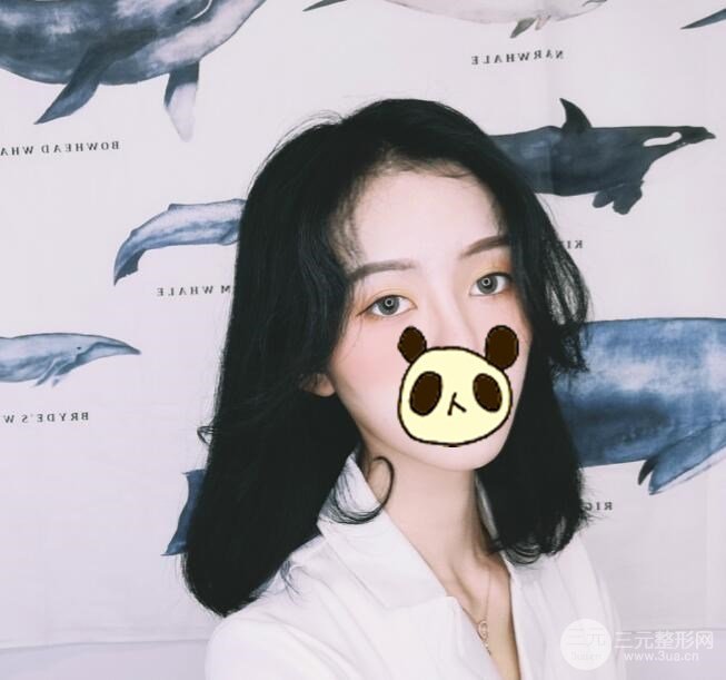 双眼皮案例术后2个月