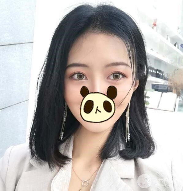 双眼皮案例术后3个月