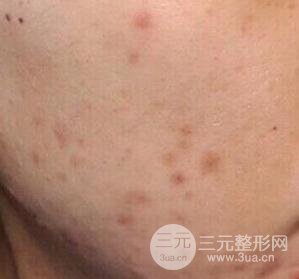 彩光祛痘果怎么样?