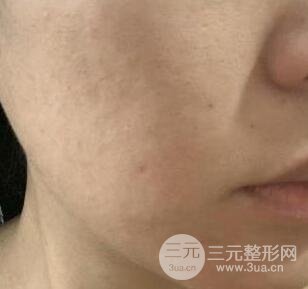 彩光祛痘果怎么样?