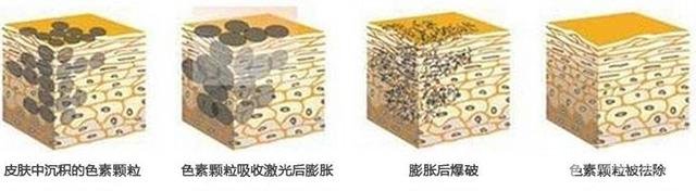 光子嫩肤建议频率