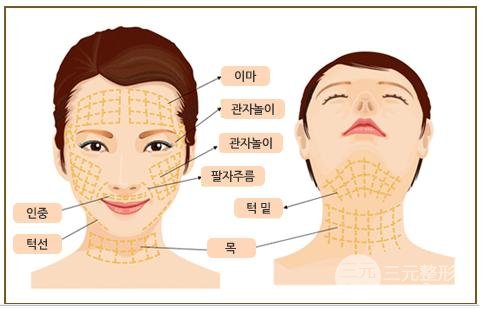 面部除皱术可以保持多长时间