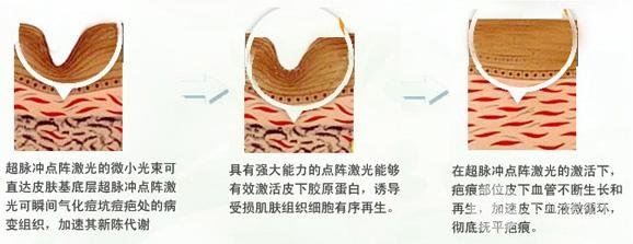 点阵激光果