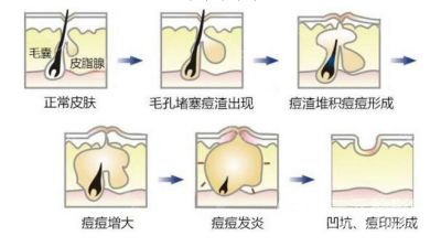 玫瑰痤疮