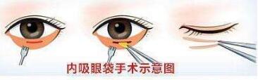 去眼袋手术