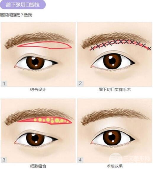 提眉整形显老的大眼睛到底应该如何回春回神