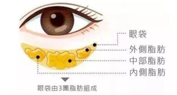 超声波眼袋有什么副作用?