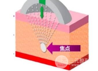 超声波眼袋有什么副作用?