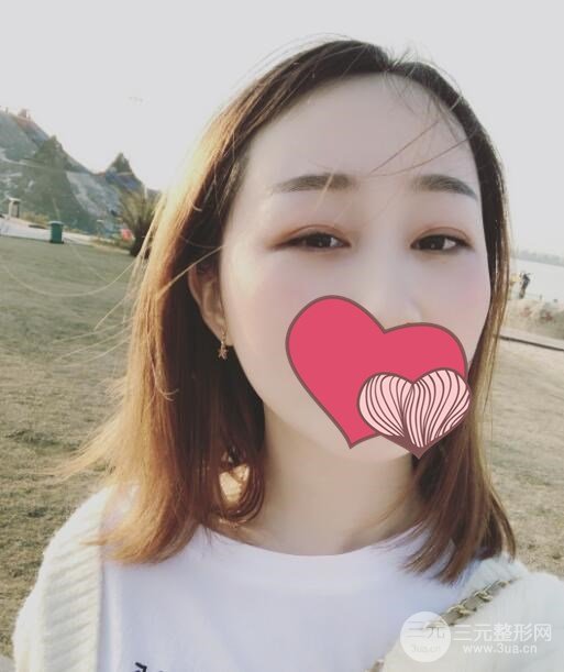 超声波去眼袋术后3周
