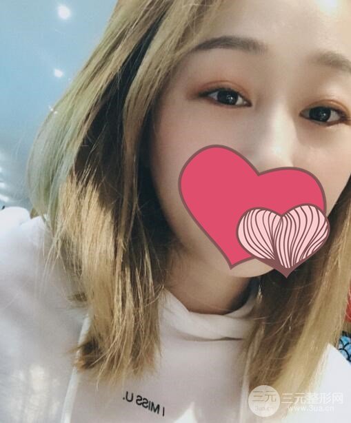 超声波去眼袋术后7周