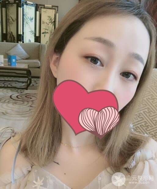 超声波去眼袋术后8周