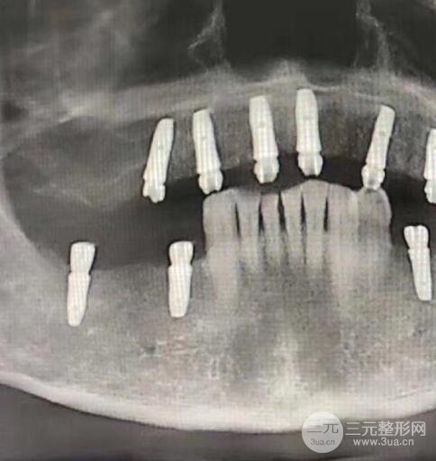 牙齿种植案例：
