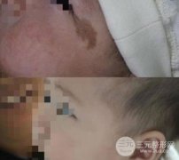 胎记缓解时间不宜迟！常见胎记及缓解手段介绍