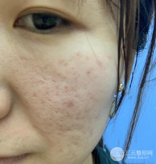 激光去痘痘体验