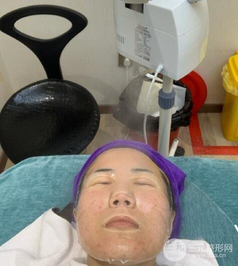 激光去痘痘体验