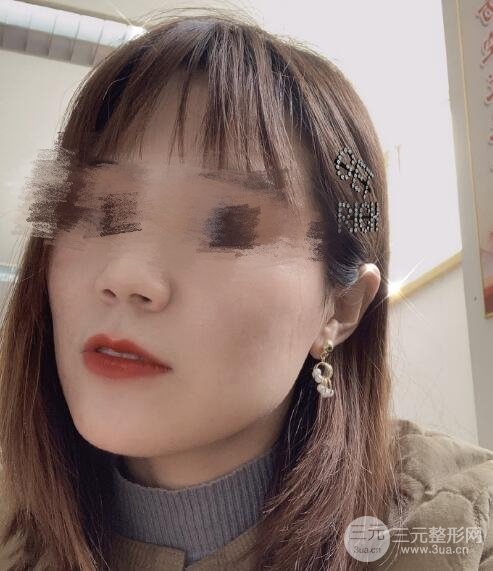 激光去痘痘果图