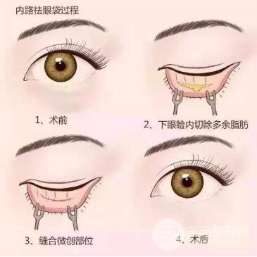 眼袋修复手术的方法包括：