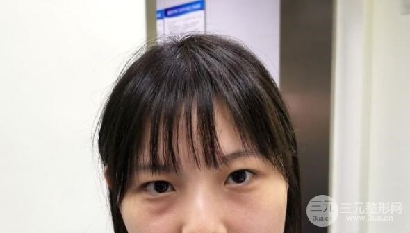 【去眼袋手术术前】
