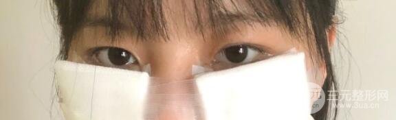 【去眼袋手术手术后】