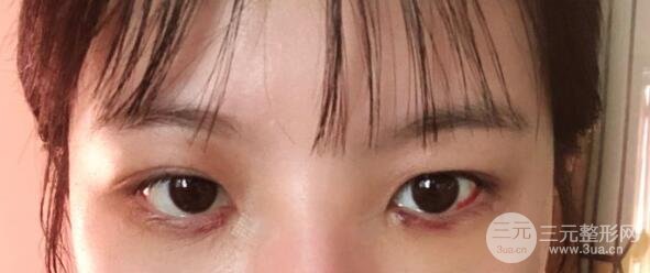 【去眼袋手术手术后恢复过程】