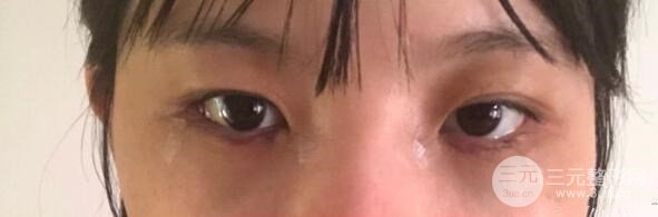 【去眼袋手术手术后恢复过程】