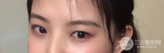 【去眼袋手术手术后恢复果】
