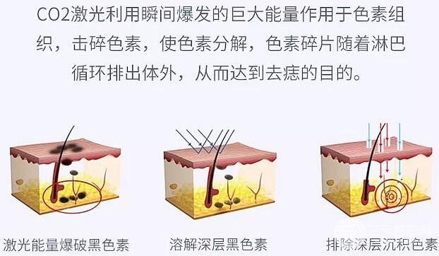 激光祛痣科普