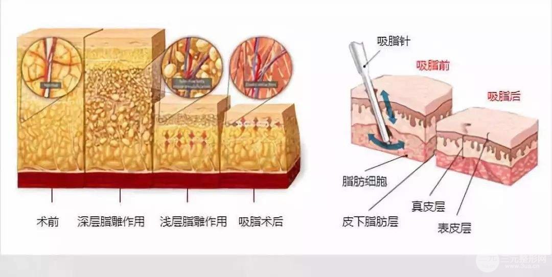 手术科普
