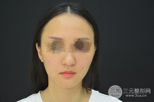 埋线除皱术前